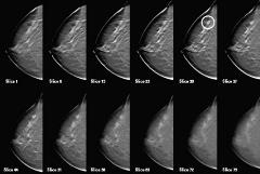 Digital Mammography