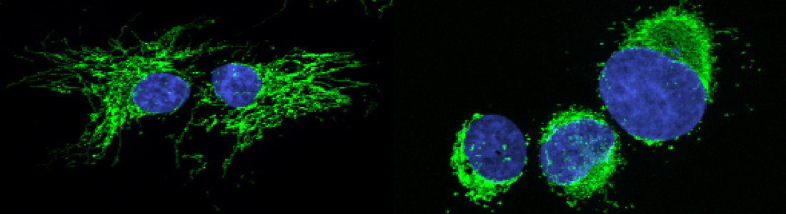 Mitochondria, Normal on Left, Tumor on Right