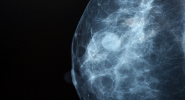 mammogram image mammogram image