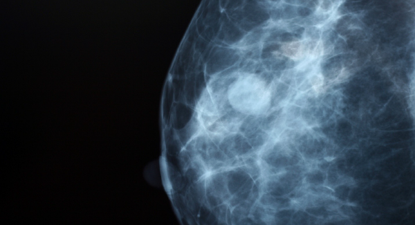 mammogram image