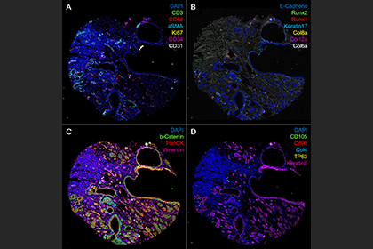 Gene expression in human breast cancer specimen analyzed by multi-spectral imaging.